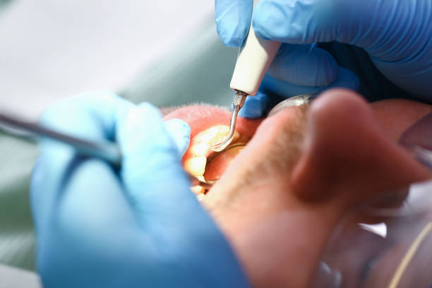 Best Emergency Wisdom Teeth Removal in Venice Gardens, FL