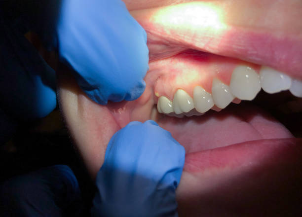 Best Urgent Care for Lost Fillings or Crowns in Venice Gardens, FL